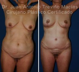 Abdominoplastia - Centro de Cirugía Plástica. Dr. Juan Antonio Treviño Macías