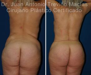 Abdominoplastia - Centro de Cirugía Plástica. Dr. Juan Antonio Treviño Macías