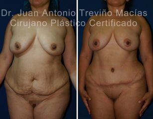 Abdominoplastia - Centro de Cirugía Plástica. Dr. Juan Antonio Treviño Macías