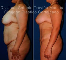 Abdominoplastia - Centro de Cirugía Plástica. Dr. Juan Antonio Treviño Macías