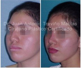 Rinoplastia - Centro de Cirugía Plástica. Dr. Juan Antonio Treviño Macías