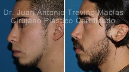 Rinoplastia - Centro de Cirugía Plástica. Dr. Juan Antonio Treviño Macías