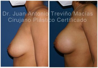 Aumento de busto - Centro de Cirugía Plástica. Dr. Juan Antonio Treviño Macías