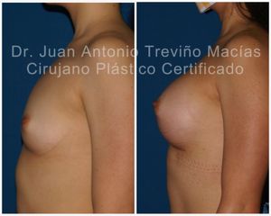 Aumento de busto - Centro de Cirugía Plástica. Dr. Juan Antonio Treviño Macías