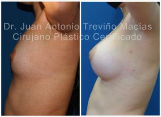 Aumento de busto - Centro de Cirugía Plástica. Dr. Juan Antonio Treviño Macías