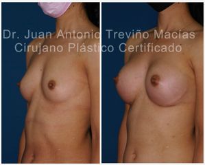 Aumento de busto - Centro de Cirugía Plástica. Dr. Juan Antonio Treviño Macías