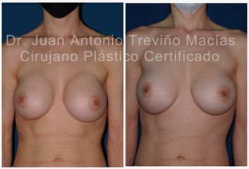 Aumento de busto - Centro de Cirugía Plástica. Dr. Juan Antonio Treviño Macías