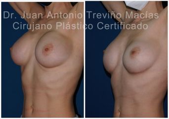 Aumento de busto - Centro de Cirugía Plástica. Dr. Juan Antonio Treviño Macías