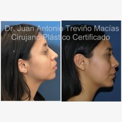 Mentoplastia - Centro de Cirugia Plástica. Dr. Juan Antonio Treviño Macías