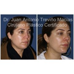 Mentoplastia - Centro de Cirugia Plástica. Dr. Juan Antonio Treviño Macías