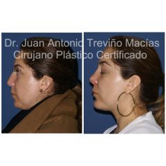 Mentoplastia - Centro de Cirugia Plástica. Dr. Juan Antonio Treviño Macías