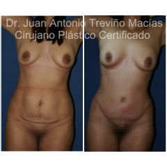 Abdominoplastia - Centro de Cirugia Plástica. Dr. Juan Antonio Treviño Macías