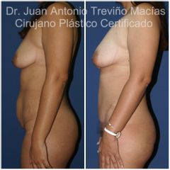 Abdominoplastia - Centro de Cirugia Plástica. Dr. Juan Antonio Treviño Macías