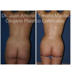 Liposucción - Centro de Cirugía Plástica. Dr. Juan Antonio Treviño Macías