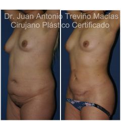Liposucción - Centro de Cirugía Plástica. Dr. Juan Antonio Treviño Macías