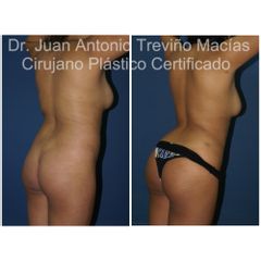 Liposucción - Centro de Cirugía Plástica. Dr. Juan Antonio Treviño Macías