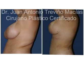 Reducción de mamas antes y después - 872068