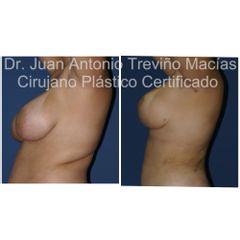 Reducción de Mamas - Centro de Cirugía Plástica. Dr. Juan Antonio Treviño Macías