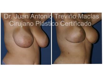 Reducción de mamas antes y después - 872069