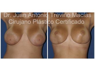 Reducción de mamas antes y después - 872070