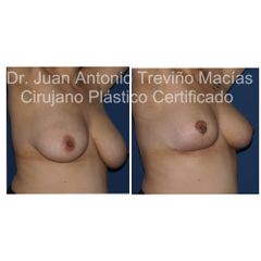 Reducción de Mamas - Centro de Cirugía Plástica. Dr. Juan Antonio Treviño Macías