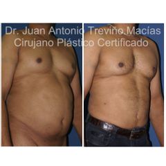 Liposucción - Centro de Cirugía Plástica. Dr. Juan Antonio Treviño Macías