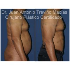 Liposucción - Centro de Cirugía Plástica. Dr. Juan Antonio Treviño Macías