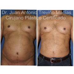Liposucción - Centro de Cirugía Plástica. Dr. Juan Antonio Treviño Macías