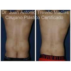 Liposucción - Centro de Cirugía Plástica. Dr. Juan Antonio Treviño Macías