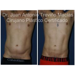 Liposucción - Centro de Cirugía Plástica. Dr. Juan Antonio Treviño Macías