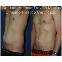 Liposucción - Centro de Cirugía Plástica. Dr. Juan Antonio Treviño Macías