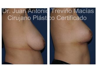 Reducción de mamas antes y después - 872082