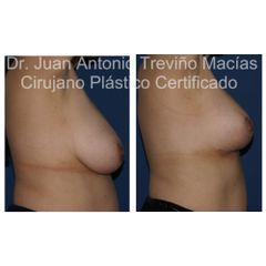 Reducción de Mamas - Centro de Cirugía Plástica. Dr. Juan Antonio Treviño Macías
