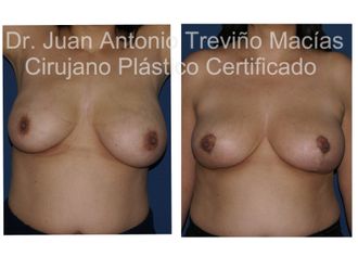 Reducción de mamas antes y después - 872083