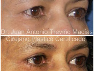 Blefaroplastia antes y después - 872084