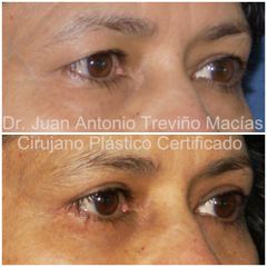 Blefaroplastia - Centro de Cirugía Plástica. Dr. Juan Antonio Treviño Macías