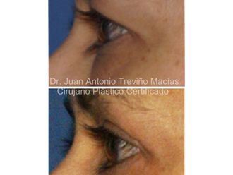 Blefaroplastia antes y después - 872085