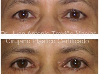 Blefaroplastia antes y después - 872086