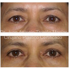 Blefaroplastia - Centro de Cirugía Plástica. Dr. Juan Antonio Treviño Macías