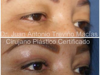 Blefaroplastia antes y después - 872087