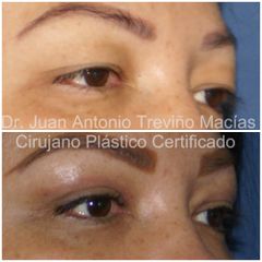 Blefaroplastia - Centro de Cirugía Plástica. Dr. Juan Antonio Treviño Macías