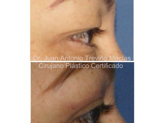 Blefaroplastia antes y después - 872088