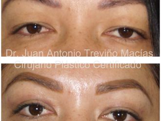 Blefaroplastia antes y después - 872089