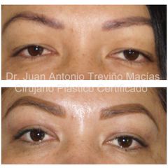 Blefaroplastia - Centro de Cirugía Plástica. Dr. Juan Antonio Treviño Macías