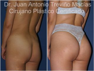 Gluteoplastia - Centro de Cirugía Plástica. Dr. Juan Antonio Treviño Macías