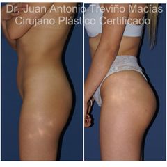 Gluteoplastia - Centro de Cirugía Plástica. Dr. Juan Antonio Treviño Macías