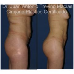 Gluteoplastia - Centro de Cirugía Plástica. Dr. Juan Antonio Treviño Macías