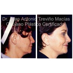 Lifting Facial - Centro de Cirugía Plástica. Dr. Juan Antonio Treviño Macías
