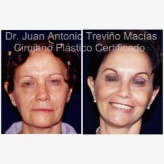 Lifting Facial -Centro de Cirugía Plástica. Dr. Juan Antonio Treviño Macías