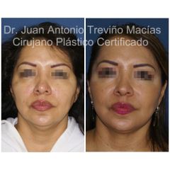 Lifting Facial -Centro de Cirugía Plástica. Dr. Juan Antonio Treviño Macías